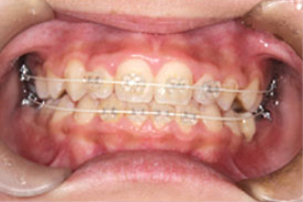 固定式のボタン装置で並べる前歯
